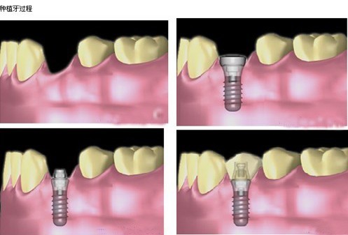 种植牙流程
