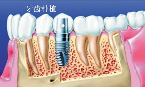 种植牙