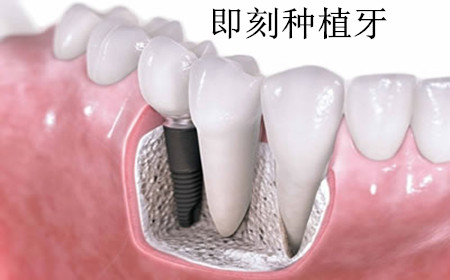 种植牙