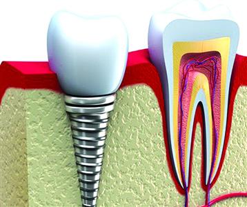 种植牙修复效果好