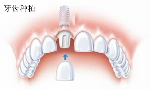种植牙