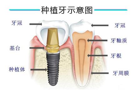 种植牙结构图