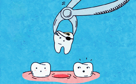 拔除患牙
